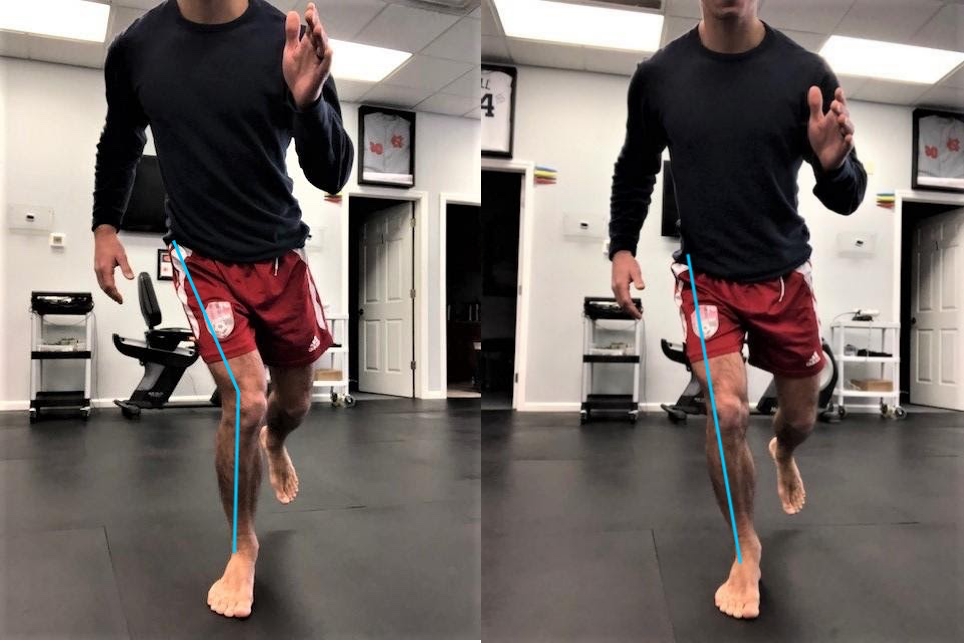 comparison photo of a knee that has collapsed inwards vs a normal straight knee alignment 