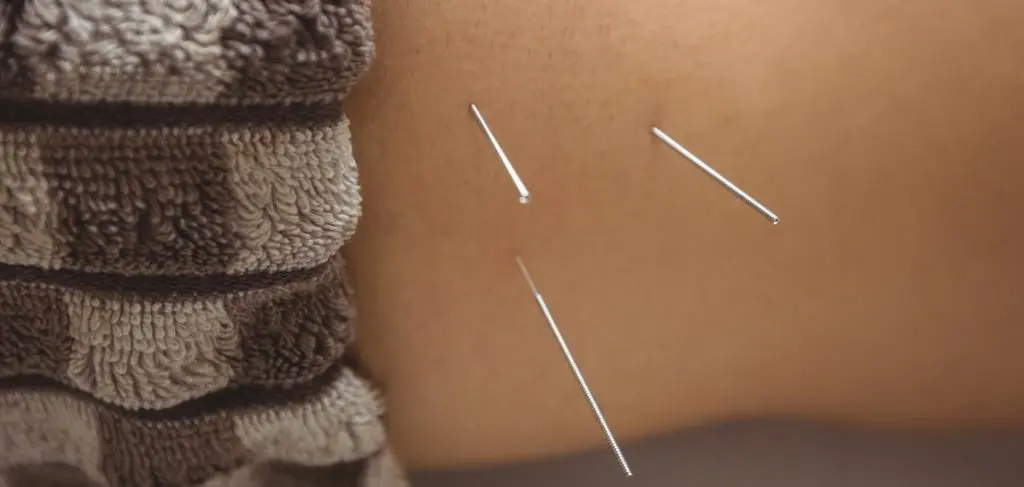 Electro-muscular Dry Needling. What is it? - Intune Sports