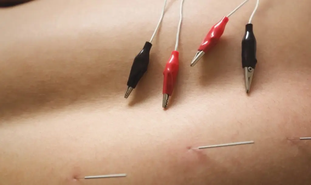 Electro-muscular Dry Needling. What is it? - Intune Sports