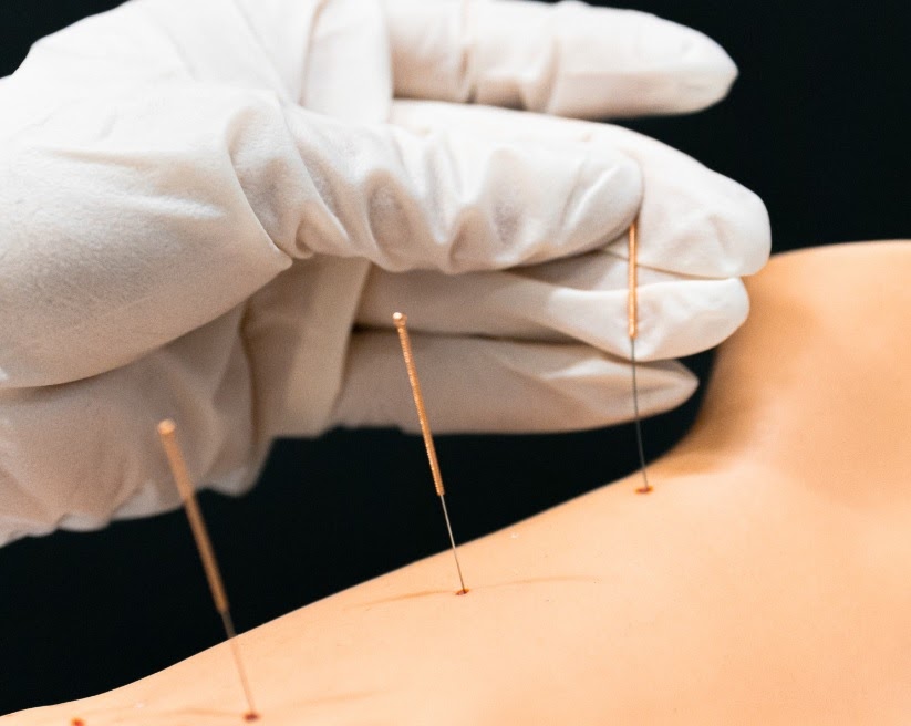 Scottsdale Electro Dry Needling by a Physical Therapist & Pricing