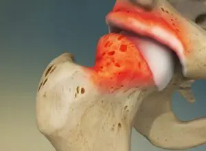 animate picture of hip impingement in bone structure