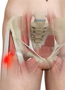 animated picture of hip tendonitis