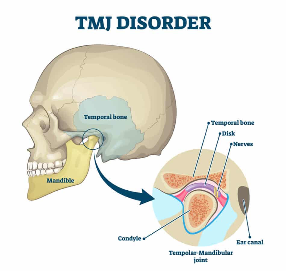 Medical illustration of a skull with a TMJ disorder