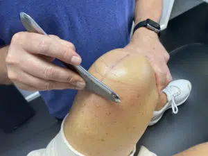 physical therapist scrapping a patient's knee with surgical scar getting ready for rehabilitation