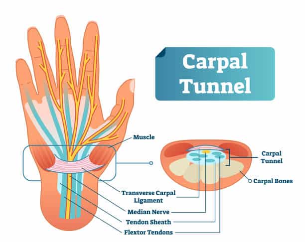 Carpal tunnel vector illustration scheme. Medical labeled diagram closeup with isolated muscle, transverse carpal ligament, median nerve, tendon sheath, flextor tendons and bones. Job and work illness