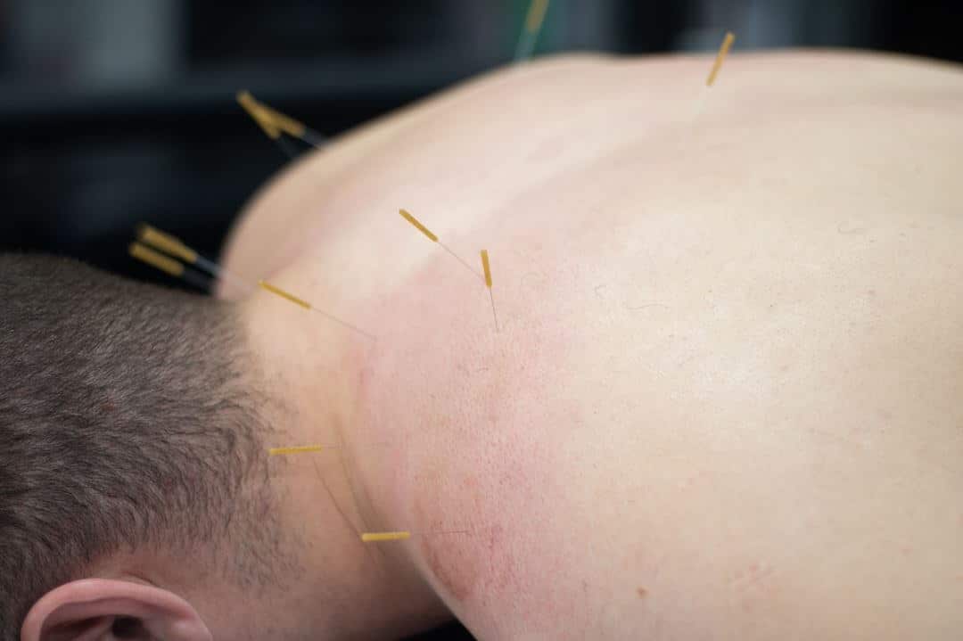 Male patient getting dry needling treatment in Knoxville